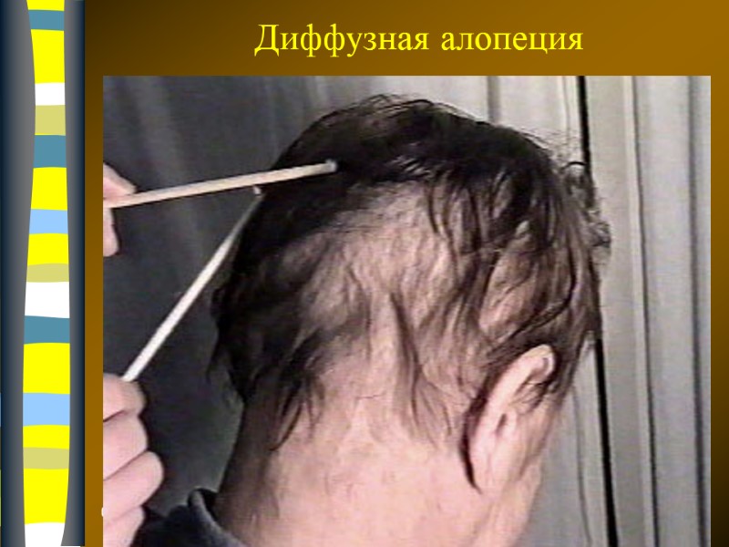 09.12.2017 Диффузная алопеция